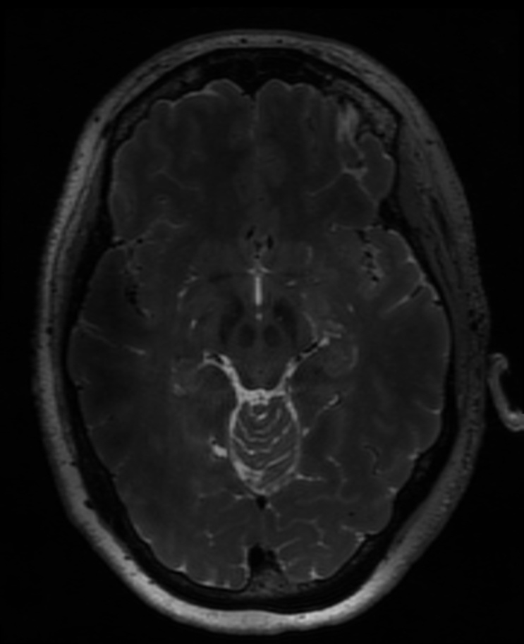 7T Neuro Images - Axial T2 CUBE Human Head TE = 77.7 TR = 2500.0