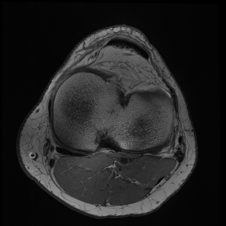 7TOrtho Images - SC-Axial T1 ARC Human Knee TE = 11.2 TR = 1125.0