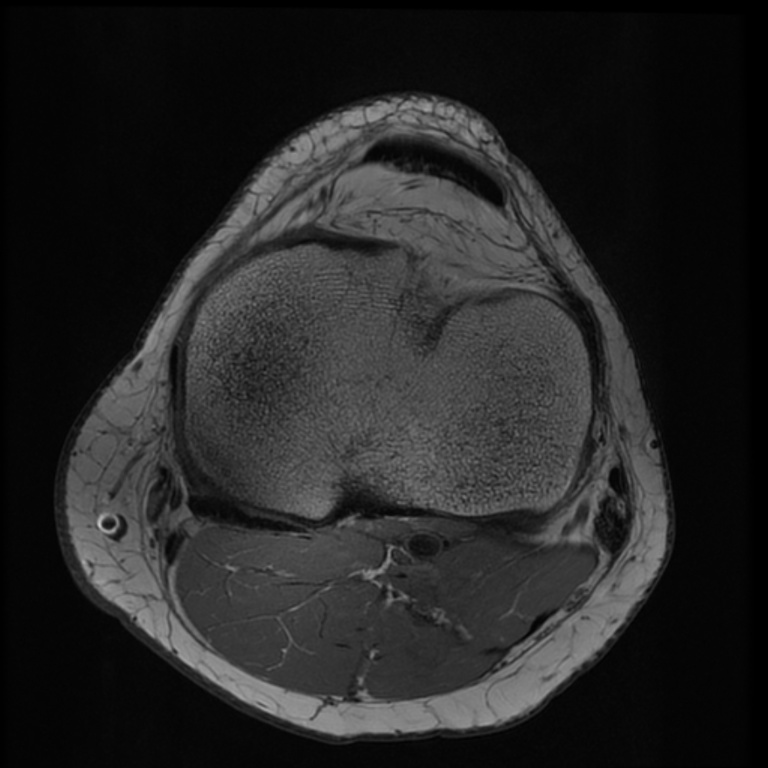 7TOrtho Images - SC-Axial T1 ARC Human Knee TE = 11.2 TR = 1125.0-1