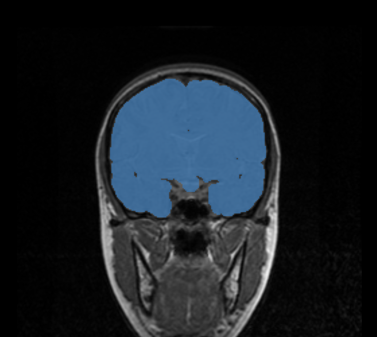 Figure (C): Coronal view of brain mask.