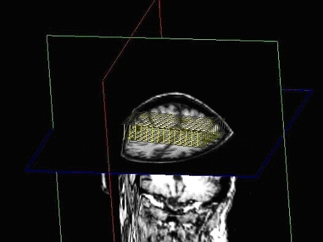 Anatomical image with spectroscopy grid registered in scanner space for visualization.