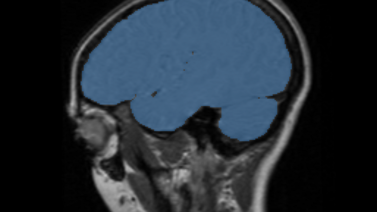 Figure (B): Saggital view of mask.